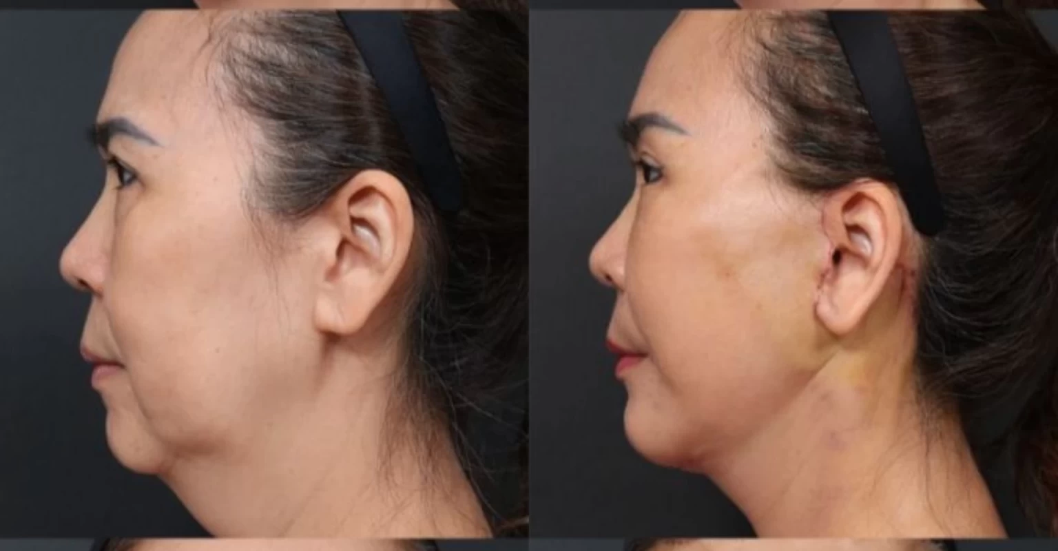 Mặt Nâng Cơ Trẻ Hóa