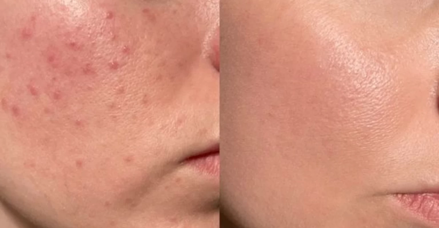 Điều Trị Mụn Đen, Mụn Trắng, Mụn Ẩn