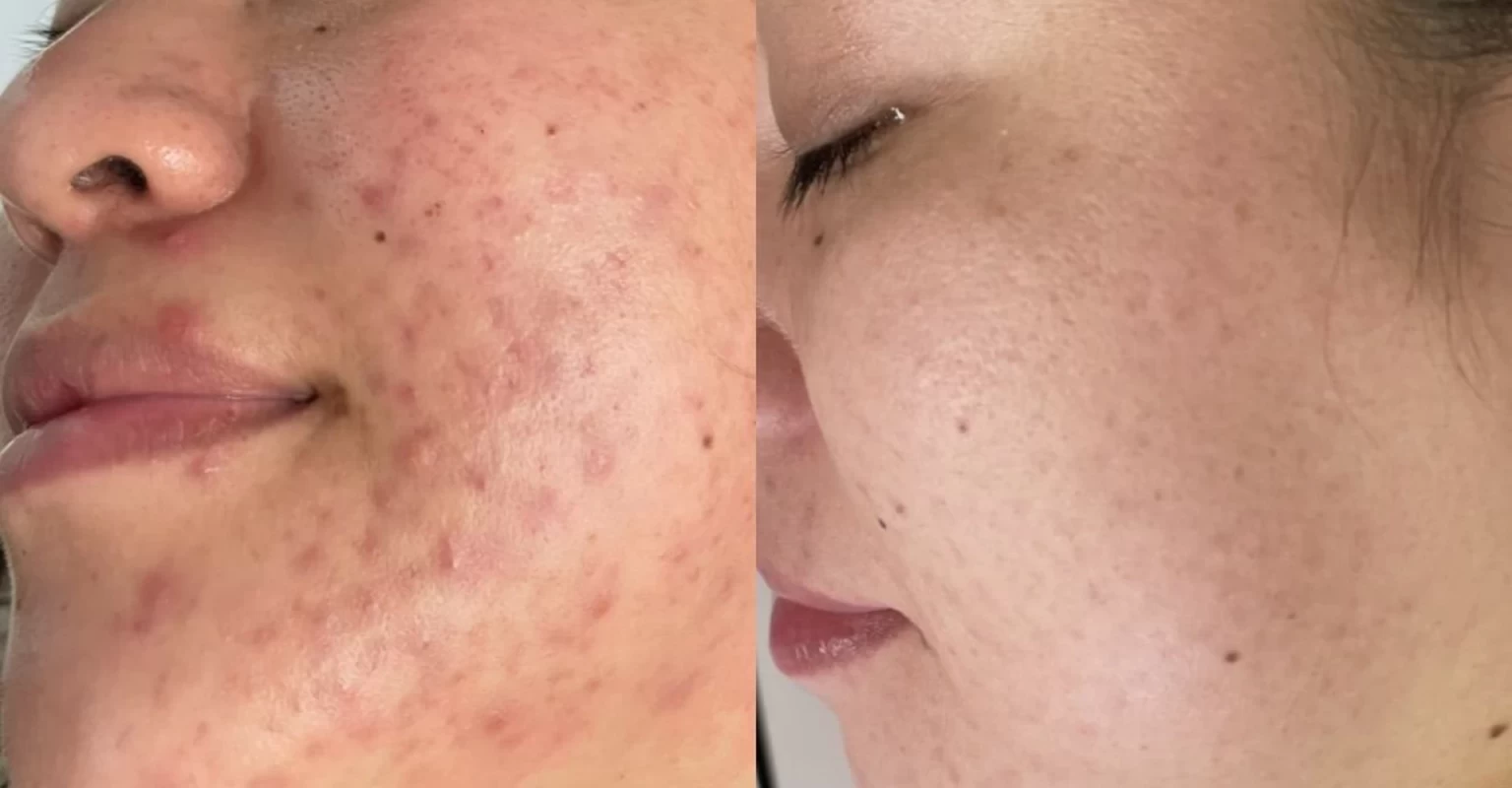Điều Trị Mụn Viêm