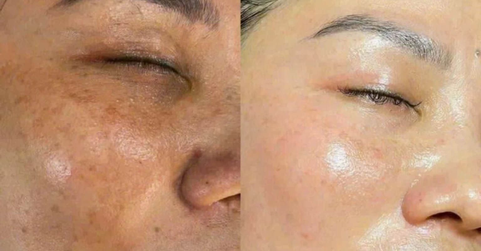 HA Facial