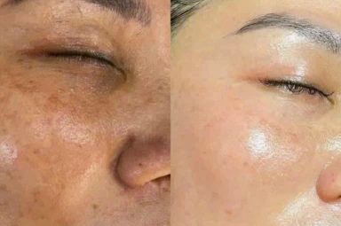 Da + Tinh Chất HA