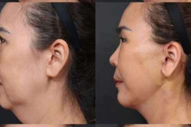 Mặt Nâng Cơ Trẻ Hóa