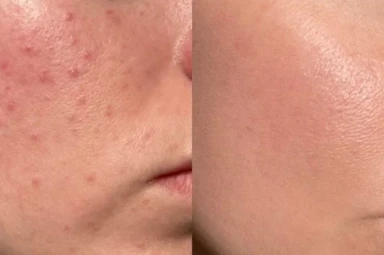 Điều Trị Mụn Đen, Mụn Trắng, Mụn Ẩn