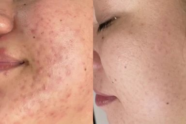 Điều Trị Mụn Viêm